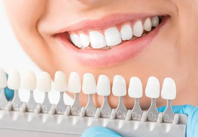 Nine Things People in Dubai Still Believe About Veneers That Are Not True